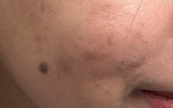 The same patient's cheek after treatment, with the papules resolved and the marks substantially faded