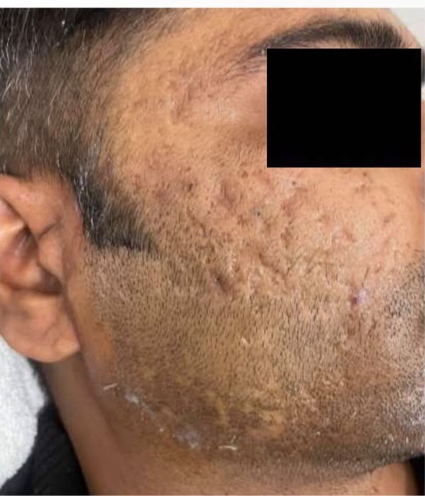 The same patient's cheek after treatment, with the scarring visibly flatter and more even